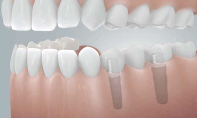 Brücke auf zwei Implantaten zum Schließen einer Schaltlücke mit drei fehlenden Zähnen