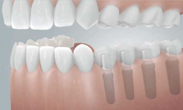 Diese Freiendsituation (vier fehlende Zähne) wurde mit vier Implantaten Zahn für Zahn geschlossen.