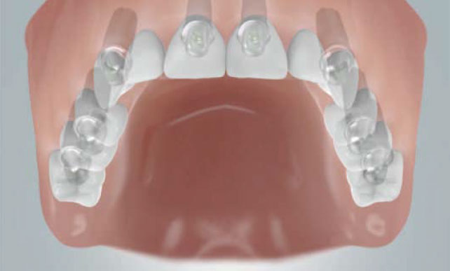 Festsitzende Brücke auf acht Implantaten zum Ersatz der ganzen Zahnreihe im Oberkiefer