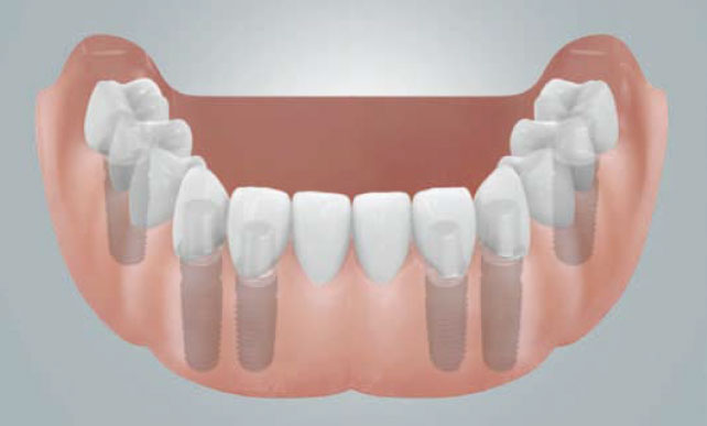 Festsitzende Brücken auf sechs Implantaten zum Ersatz der ganzen Zahnreihe im Unterkiefer