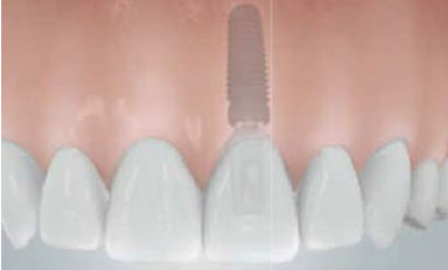 implantatversorgung-mittleren-schneidezahns